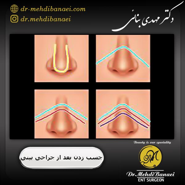 چسب زدن بینی بعد از جراحی 