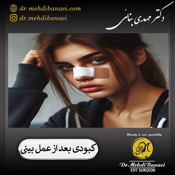 کبودی بعد از عمل بینی - دکتر مهدی بنائی