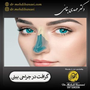 گرافت در جراحی بینی _ دکتر مهدی بنائی