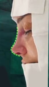 عمل بینی ترمیمی درارومیه _ دکتر مهدی بنائی
