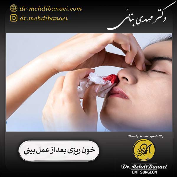 خون ریزی بعد از عمل بینی _ دکتر مهدی بنائی
