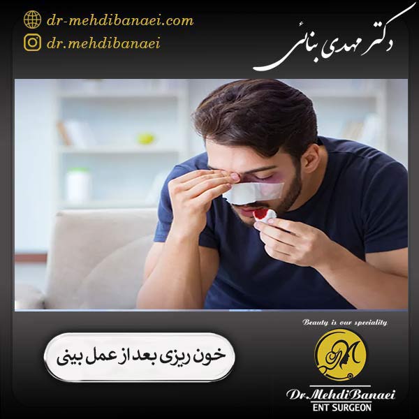 خون ریزی بعد از جراحی بینی _ دکتر مهدی بنائی
