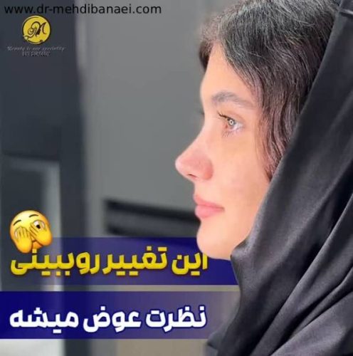 جراحی-بینی-241